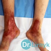 Trophic ulcer on both lower limbs in the end of treatment
