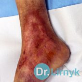 Trophic ulcer on right lower limb. Result of treatment during 2 months. Large view 