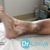 Trophic ulcer of left lower leg (outer surface) during treatment
