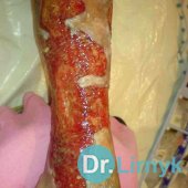 Trophic ulcer on the left lower limb. View of the inner surface