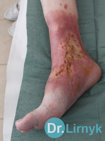 Trophic ulcer on the right leg before treatment