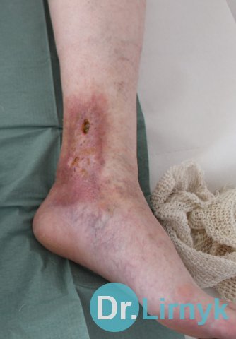Trophic ulcer on the left leg, which was not heal for 15 years