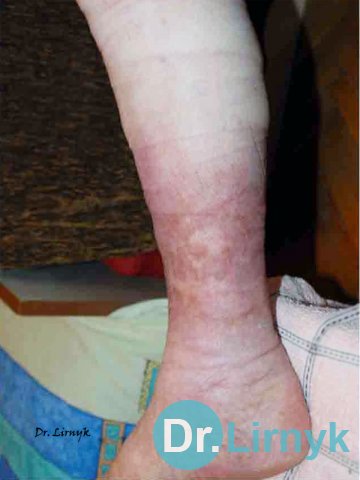Гипертоническая язва: конец лечения. Полное восстановление кожных покровов.