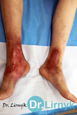 Trophic ulcer on both lower limbs in the end of treatment