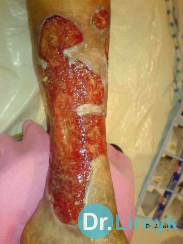 Trophic ulcer on the left lower limb. View of the inner surface