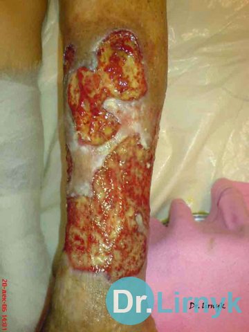 Trophic ulcer on the left lower limb. View of the back surface