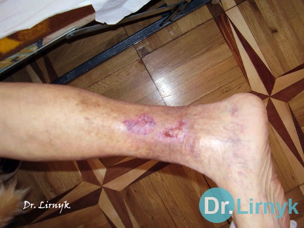 Trophic ulcer on the right leg - the end of treatment, healed ulcer