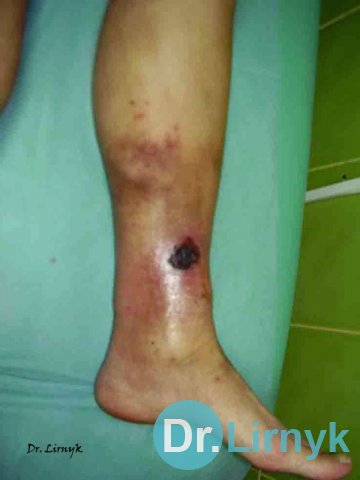 Trophic ulcer on the leg, acute cellulitis indurativnyy, fascia - compression syndrome, pain syndrome.