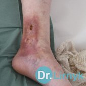 Trophic ulcer on the left leg, which was not heal for 15 years