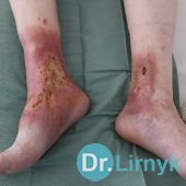 Trophic ulcer on both legs, which was not heal for 15 years, foto before treatment