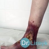 Trophic ulcer on right lower limb. Large view at the beginning of treatment.