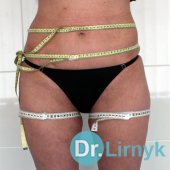 Result: Reduction in waist circumference and hip to 4 cm after 10 procedures. Restored skin elasticity.