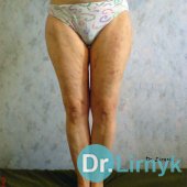 Целлюлит после лечения 2 - Уменьшение окружности талии и бедер на 7 см. после 12 процедур. Восстановление эластичности кожи.