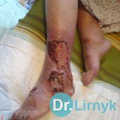Trophic ulcer on both legs before treatment
