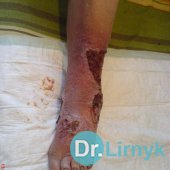 Trophic ulcer before treatment. Large view photo of the right lower limb.