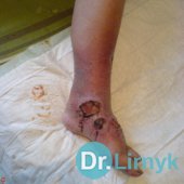 Trophic ulcer before treatment. Large view photo of the left lower limb.