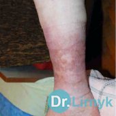 Гипертоническая язва: конец лечения. Полное восстановление кожных покровов.