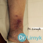 Varicose veins: the end of treatment