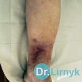 Trophic ulcer in the middle of treatment, the patient 77 years old