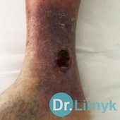 Трофическая язва. Язва Trophic ulcer. The ulcer did not heal 7 years. Unsuccessful attempt to transplant skin. The patient is 76 years old.