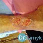 Trophic ulcer on the right leg before treatment