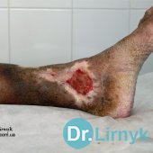 Trophic ulcer of left tibia on the inner surface during the treatment