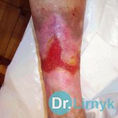 Trophic ulcer on the left lower limb in the middle of treatment