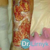 Trophic ulcer on the left lower limb. View of the back surface