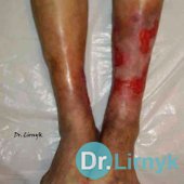 Trophic ulcer on both lower limb in the middle of treatment