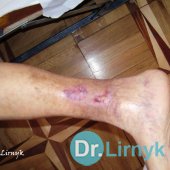 Trophic ulcer on the right leg - the end of treatment, healed ulcer