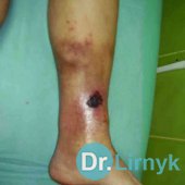 Trophic ulcer on the leg, acute cellulitis indurativnyy, fascia - compression syndrome, pain syndrome.