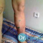 Varicose veins: the process of treatment, marking sutures before surgery