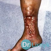 Varicose ulcer: the beginning of treatment