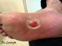 Trophic ulcer with underlying arterial insufficiency of the lower limb