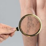 Лікування варикозу