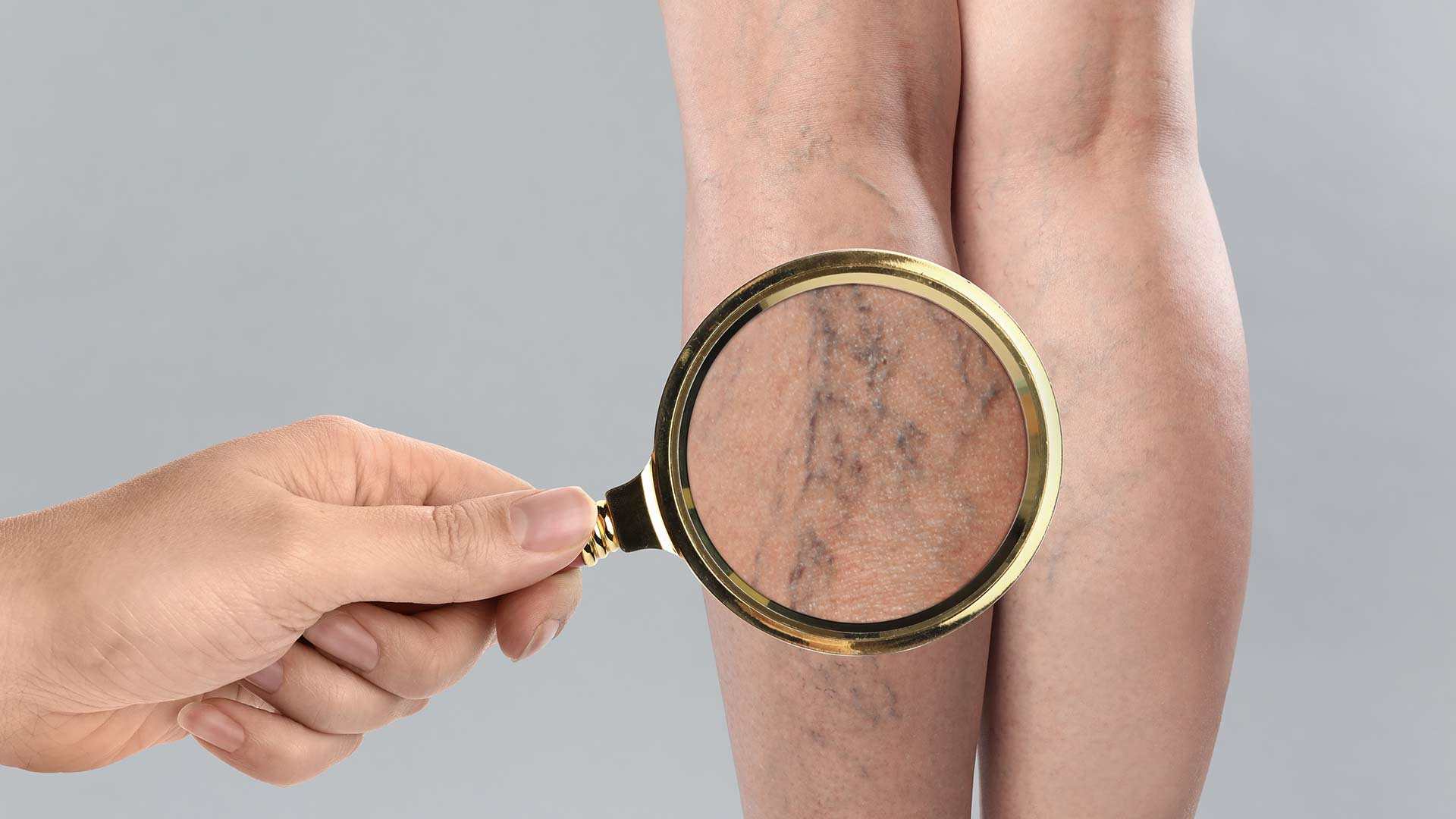 Ви зараз переглядаєте Лікування варикозу