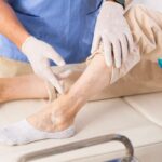 Ретикулярний варикоз