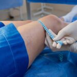 Лімфостаз (лімфедема) нижніх кінцівок